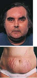 Cushing's syndrome_img